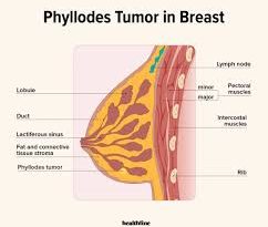 diagnosing-phyllodes-tumors-what-every-patient-should-know