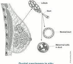 exploring-the-stages-of-breast-cancer-from-dcis-to-ilc