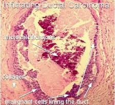 invasive-ductal-carcinoma-a-closer-look-at-the-most-common-breast-cancer