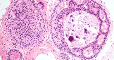 the-basics-of-invasive-ductal-carcinoma-idc