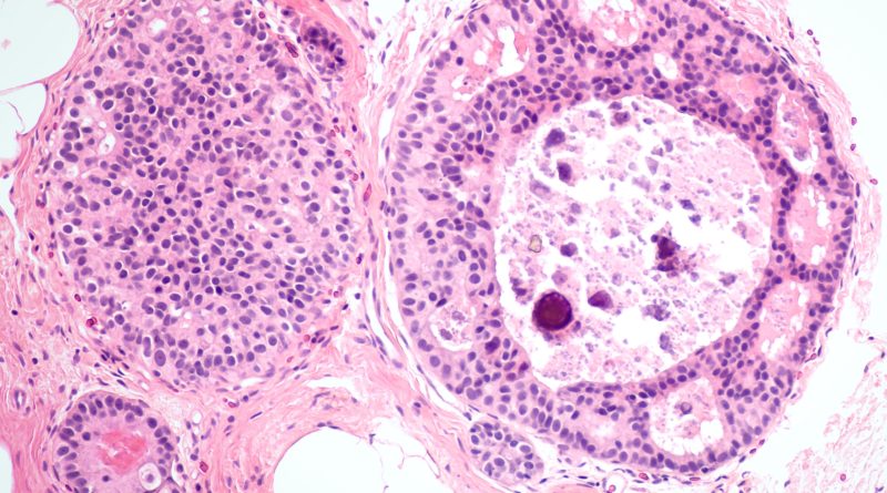 the-basics-of-invasive-ductal-carcinoma-idc