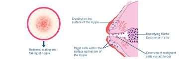 the-connection-between-paget-disease-and-breast-cancer