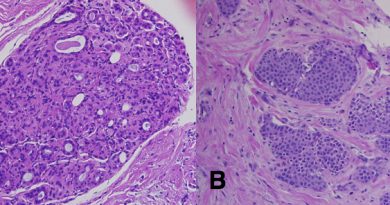 understanding-ductal-carcinoma-in-situ-dcis-early-detection-matters